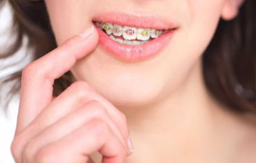 Los brackets de colores, el último grito estético