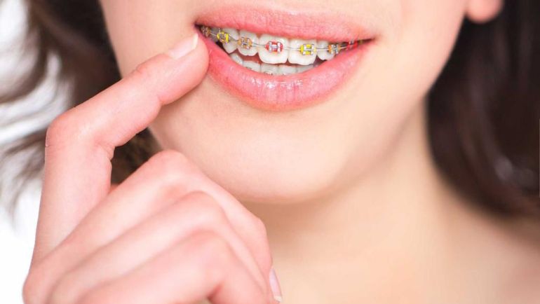 Los brackets de colores, el último grito estético