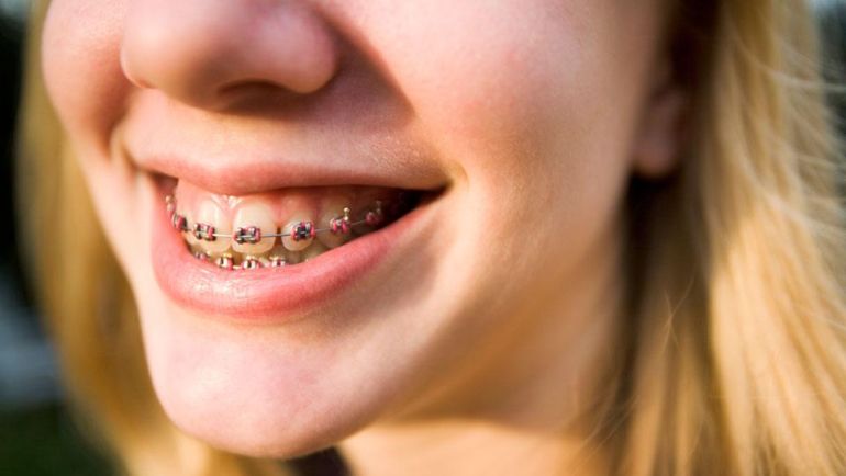 Brackets: qué tenés que saber si querés ponerte aparatos