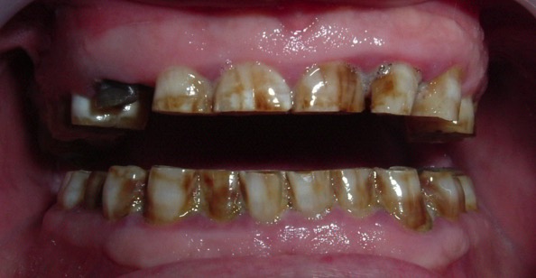 Bruxismo, Realidades y Mitos